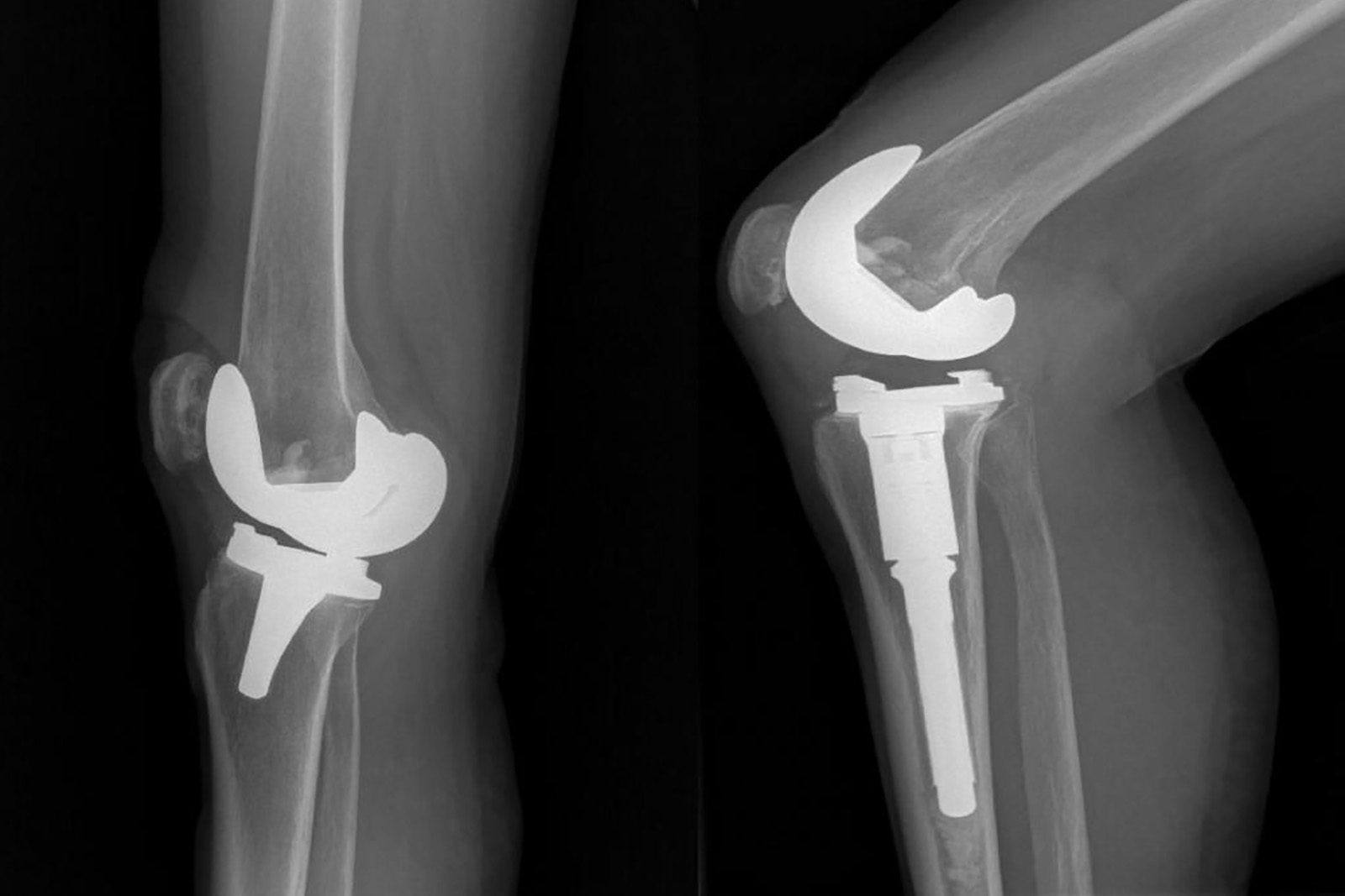 Radiografía de deos rodillas con prótesis en los huesos