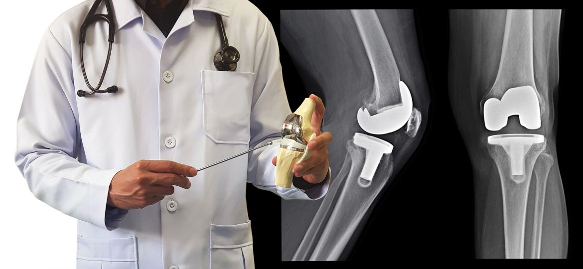 Fotografía de un médico mostrando el funcionamiento de una prótesis de rodilla, con radiografías de la situación final de la prótesis