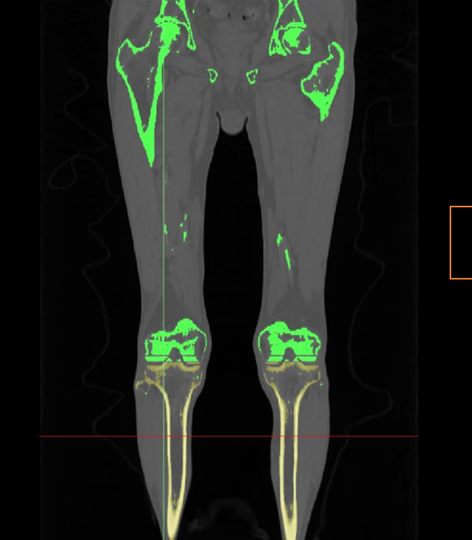 Radiografía de cadera y piernas
