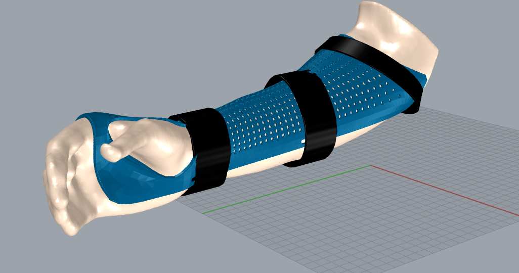 ODISEA3D_innovacion_biomecanica_europa_ortesis